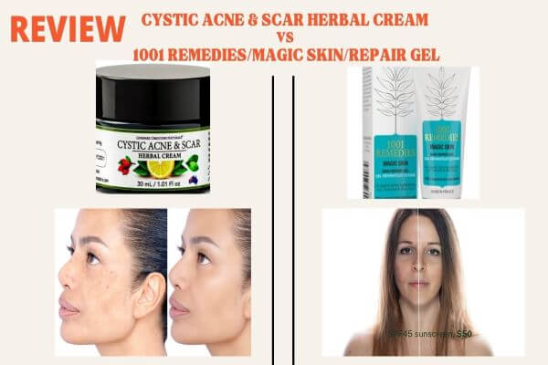 review of cystic acne and scar repair herbal cream vs 1001 remedies
