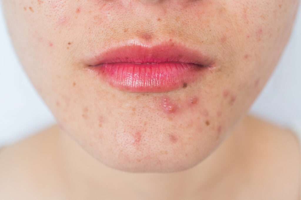 Healthy Skin Care Tips – 10 Habits To Avoid For Acne Prone Skin