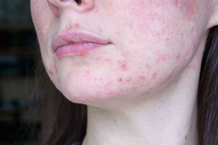 Inflammatory acne, how regular acne medications work