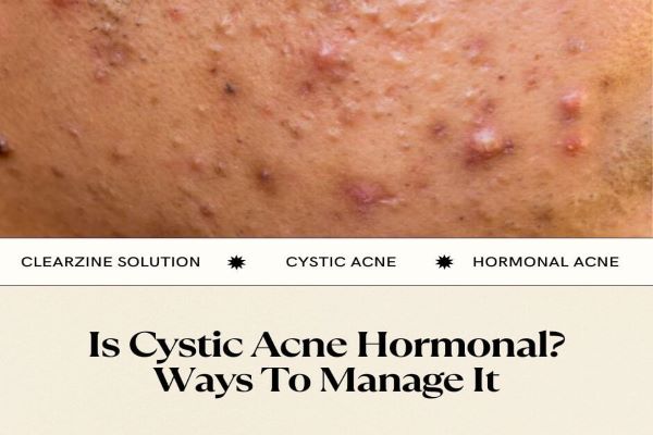 How to Manage Cystic Acne
