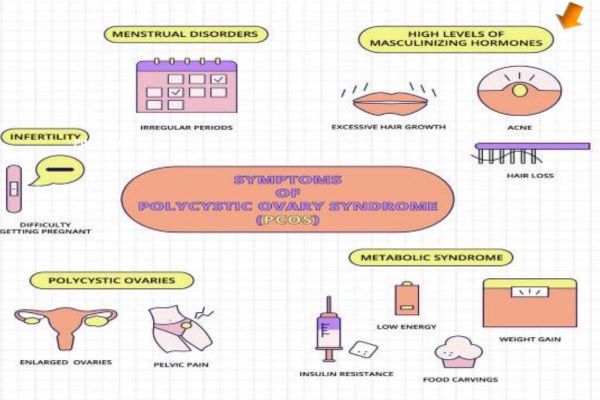 PCOS related acne