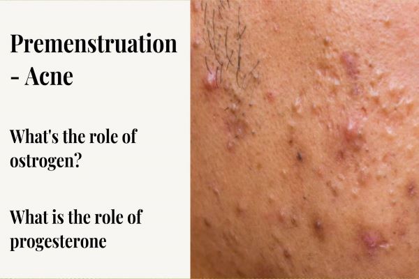 premenstruation acne prgesterone and estrogen