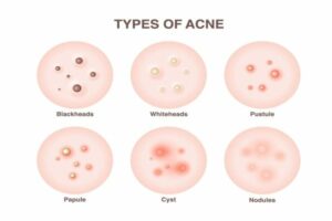 Types of acne