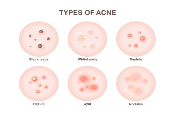 Is cystic acne hormonal
