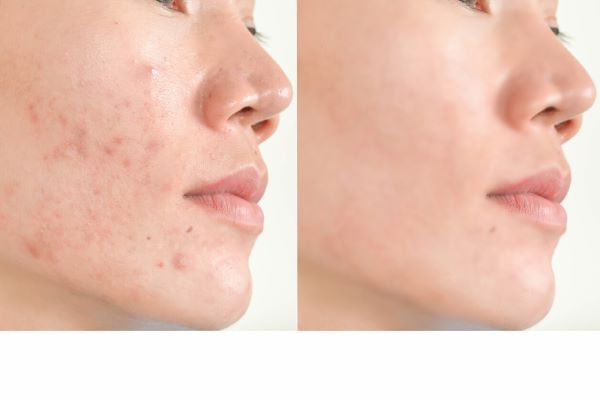 Benefits of treating acne - before and after photo