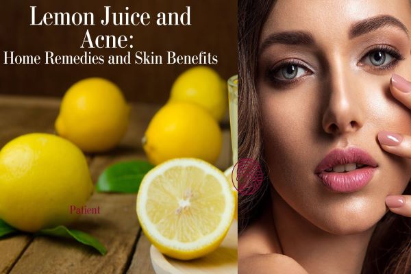Lemon Juice and acne