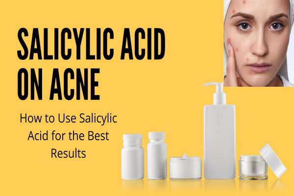 Salicylic acid on acne