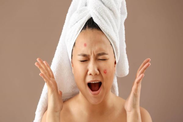 what is stress acne and what causes it