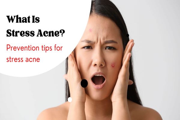 What is stress acne and ways to prevent it
