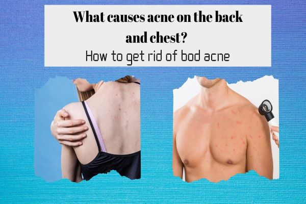 what causes acne on the back and chest?