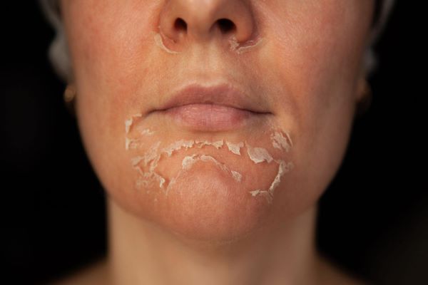 side effects of at home chemical peel