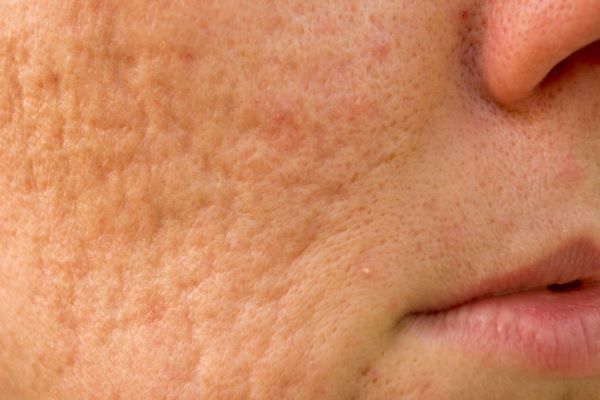 acne scars
