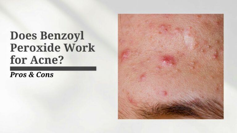 Does Benzoyl Peroxide Work For Acne Pros And Cons Acne Skincare For Acne 