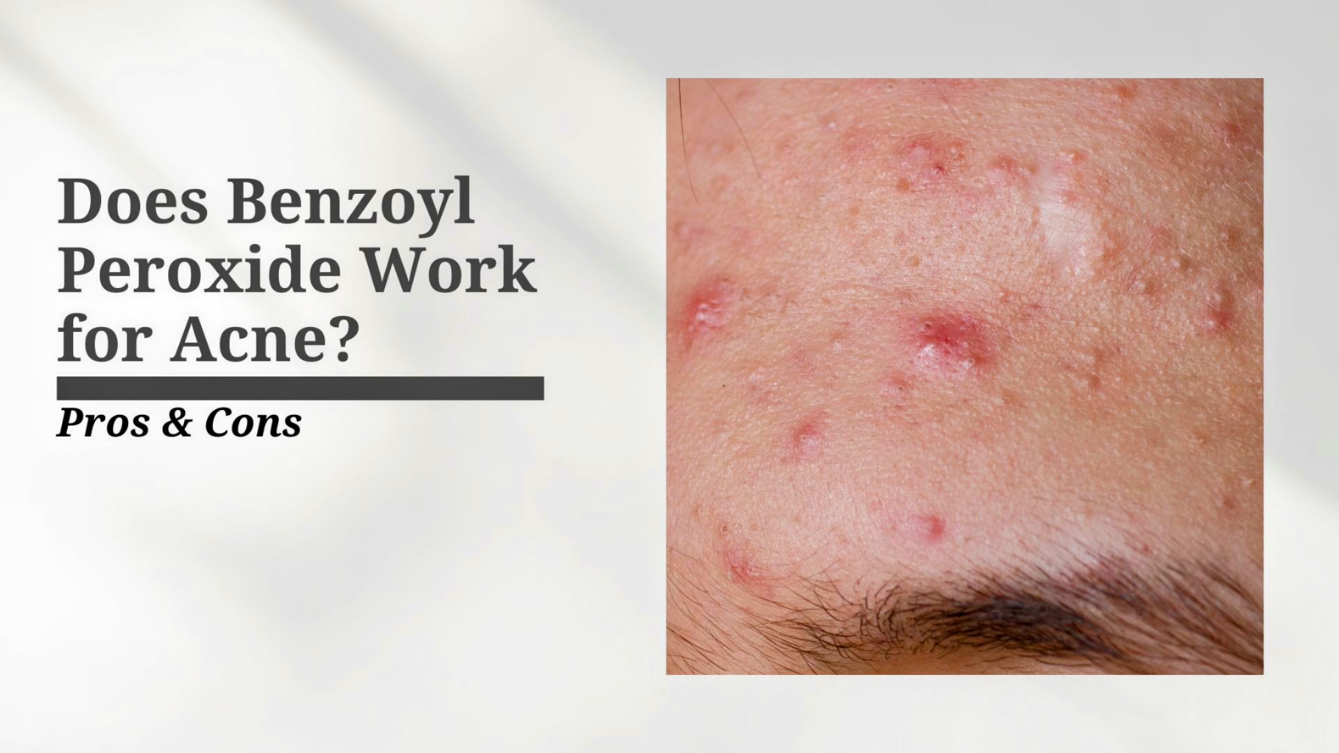 Does Benzoyl Peroxide Work for Acne