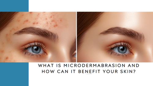 What is Microdermabrasion and How Can It Benefit Your Skin?