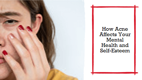 How Acne Affects Your Mental Health and Self-Esteem