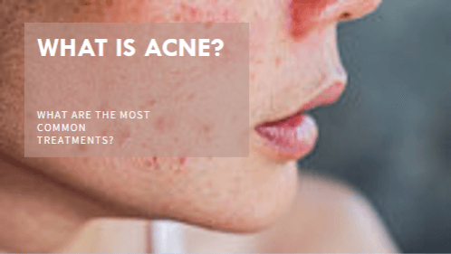What is acne and what are the most common treatments?